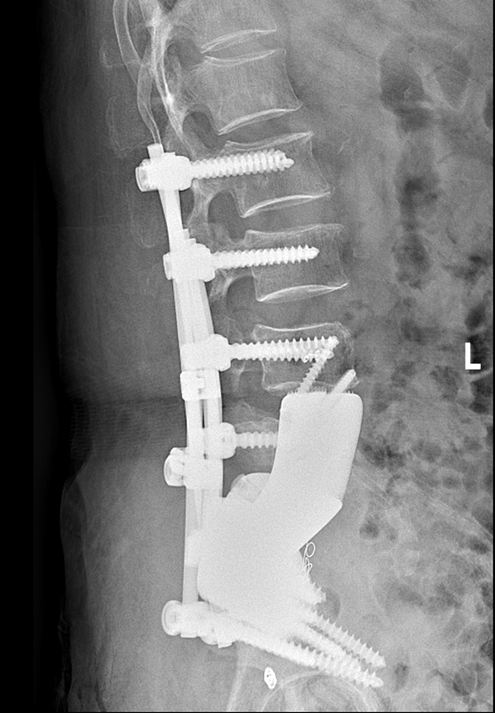 術后腰椎側位X線。