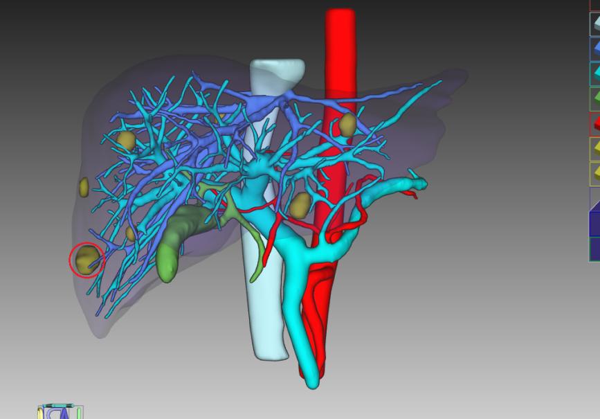 術前全量化三維重建。