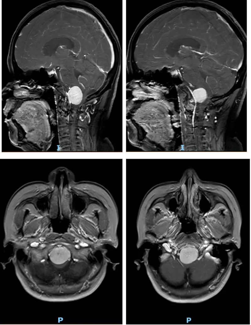 罕见肿瘤深藏“生命中枢”风险极高。