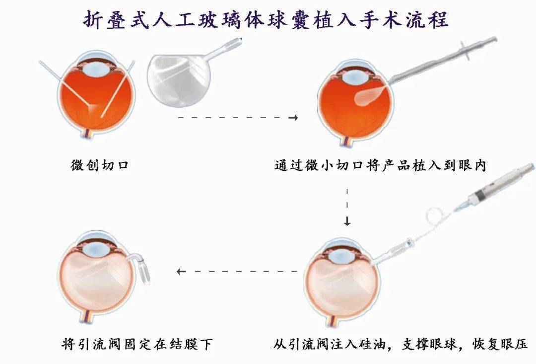 FCVB手术流程示例图。
